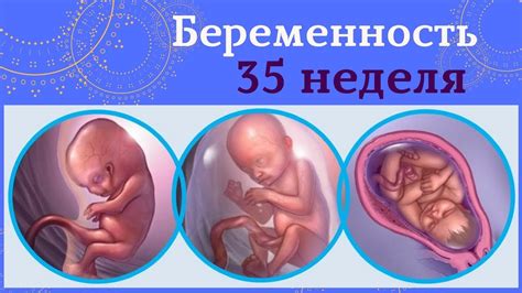 Риски и последствия утечки вод в 35-ой неделе беременности