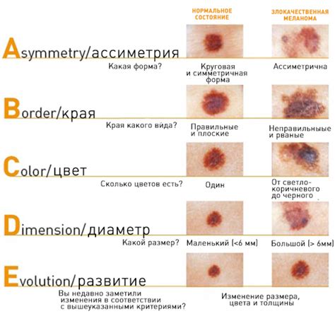 Роль генетического варианта и его связь с развитием меланомы