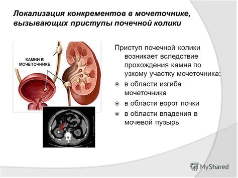 Роль питания в формировании конкрементов в мочевой системе