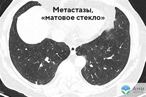 Роль рентгеновского изображения в диагностике уплотнения корней легких