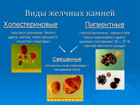 Роль употребления напитков в процессе растворения желчных камней