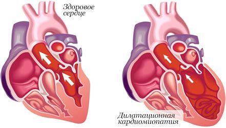 Роль хронических заболеваний в формировании кардиомиопатии