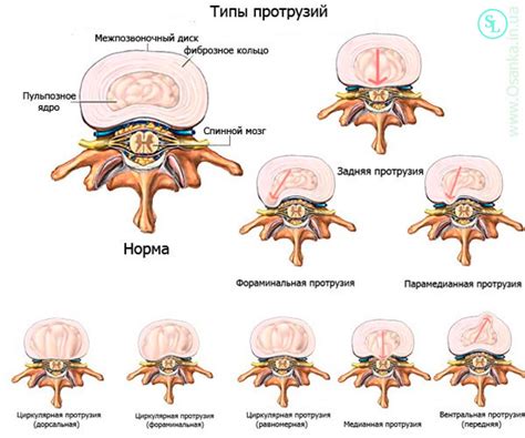 Симптомы и диагностика дорзальной выступления диска L4-L5