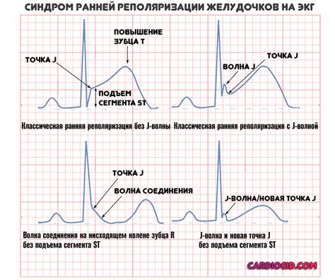 Симптомы и диагностика неспецифических нарушений реполяризации на ЭКГ