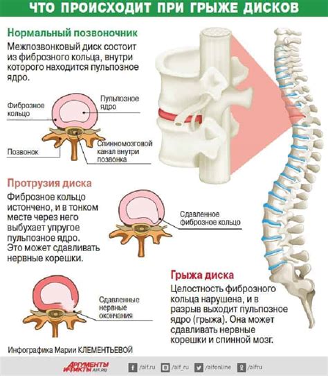 Симптомы и диагностика повреждения межпозвоночных дисков: понимание проблемы и поиск решений