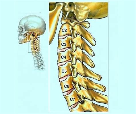 Симптомы и последствия без диска между позвонками