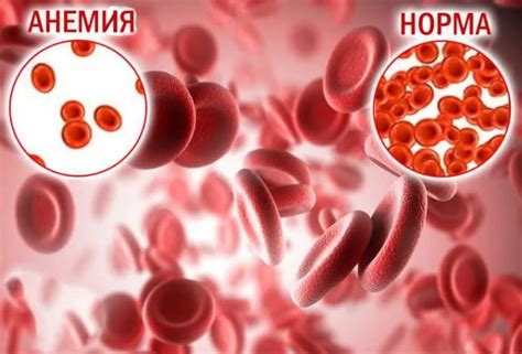 Симптомы и проявления малоклеточности анемии