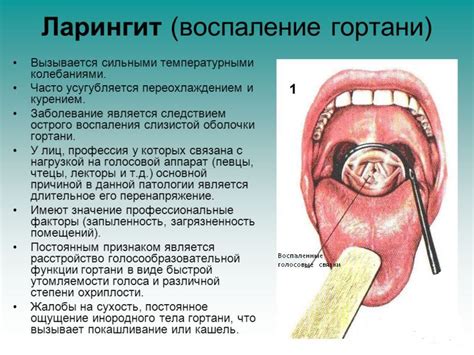 Симптомы ларингита, которые помогут определить болезнь и принять необходимые меры
