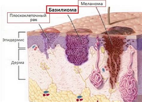 Спонтанная опухоль на коже головы: недостоверное представление о родинке или опухолевом образовании