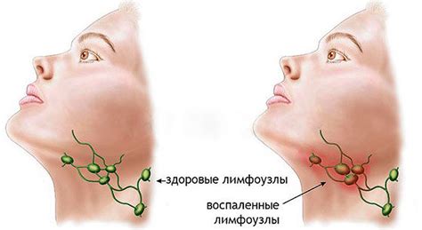 Способы устранения увеличения лимфатических узлов под челюстью