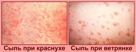 Сыпь при определенных системных заболеваниях и способы воздействия