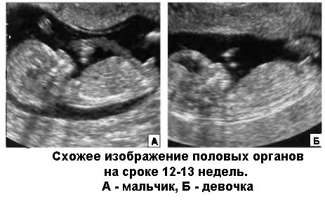 Точный способ определения пола ребенка при помощи ультразвукового исследования