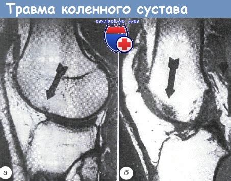 Травма поворотного сустава