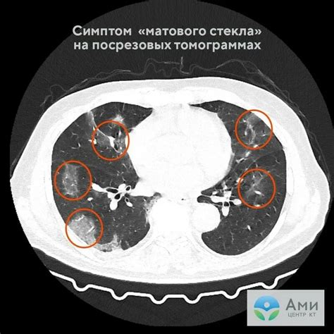 Традиционные методы для улучшения состояния после КТ легких