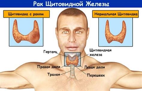 Увеличение щитовидной железы с помощью медикаментов