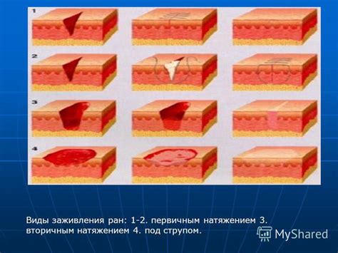 Ускорение процесса выздоровления и заживления раны