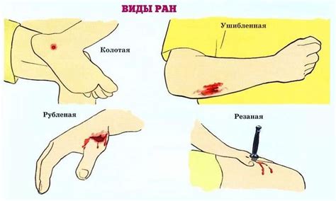 Уход за поврежденной областью после раны пальца