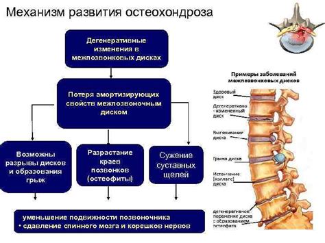 Факторы, способствующие возникновению патологических изменений в межпозвонковых дисках