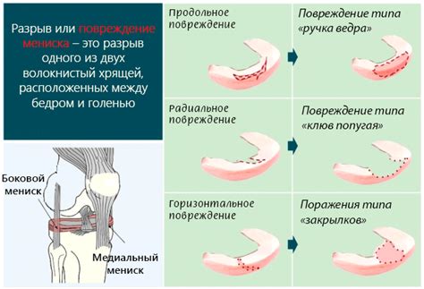 Факторы, способствующие формированию дегенеративных изменений менисков