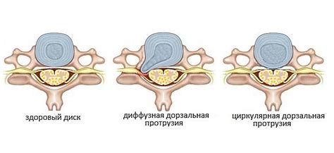 Факторы риска и влияние на дегенерацию диска при дорзальной экструзии L4-L5