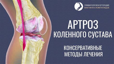 Хирургические методы лечения нестабильности коленного сустава