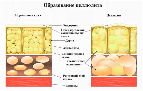 Целлюлит: причины и последствия