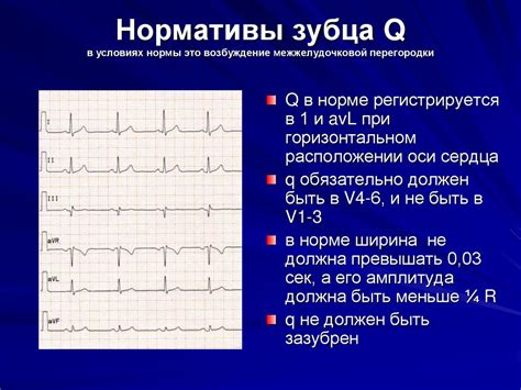 Что значит нетипичная ЭКГ