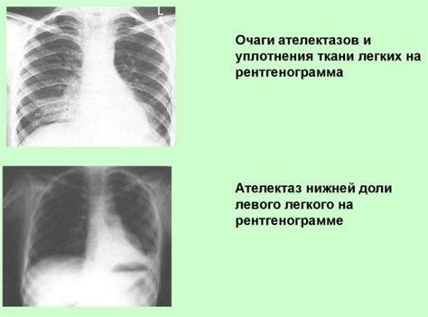 Что означает понятие "очаг уплотнения в легких"?