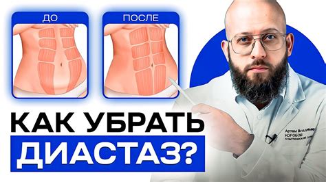 Что такое диастаз и важность его проверки