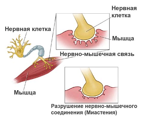 Что такое миастения и как ее обнаружить?