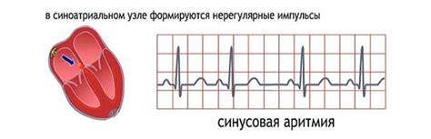 Что такое нерегулярный ритм сердца?