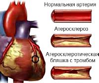 Что такое нестабильная стенокардия