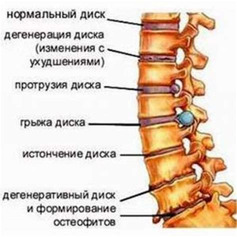 Что такое поражение межпозвоночных дисков в поясничной области?