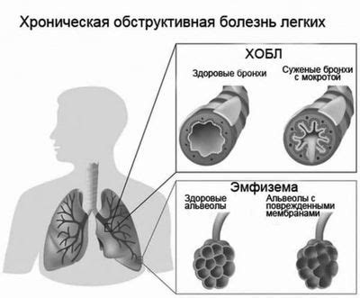 Что такое синдром хронической обструктивной болезни легких и как его выявить?