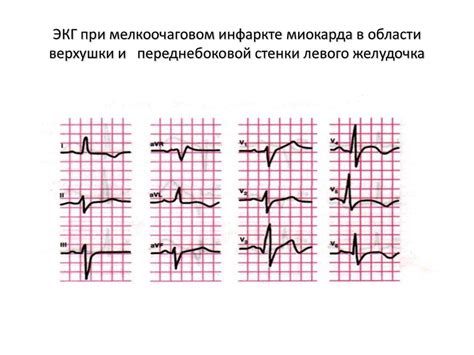 ЭКГ - неотъемлемый инструмент в выявлении изменений сердечной мышцы левого камерного отдела