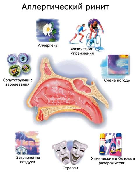  Аллергический ринит: симптомы, факторы возникновения, способы лечения 