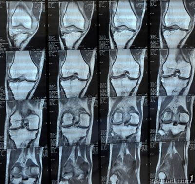  Использование рентгеновской диагностики для оценки состояния хрящей в суставе колена 