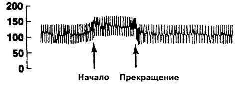  Основные принципы проведения пробы Вальсальвы 