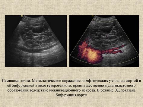  Ультразвуковое исследование лимфатической системы